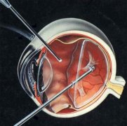眼底病的三種專業治療方法